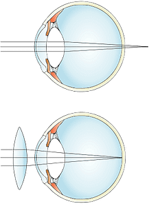 oko i projekcija dalekovidnosti na oku