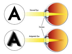 primjer ocne jabucice sa i bez astigmatizma